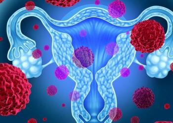 Саркома шейки и тела матки: прогноз, симптомы, рецидив и пути лечения Эндометриоидная саркома