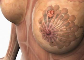 Причины, симптомы и лечение фиброаденоматоза груди